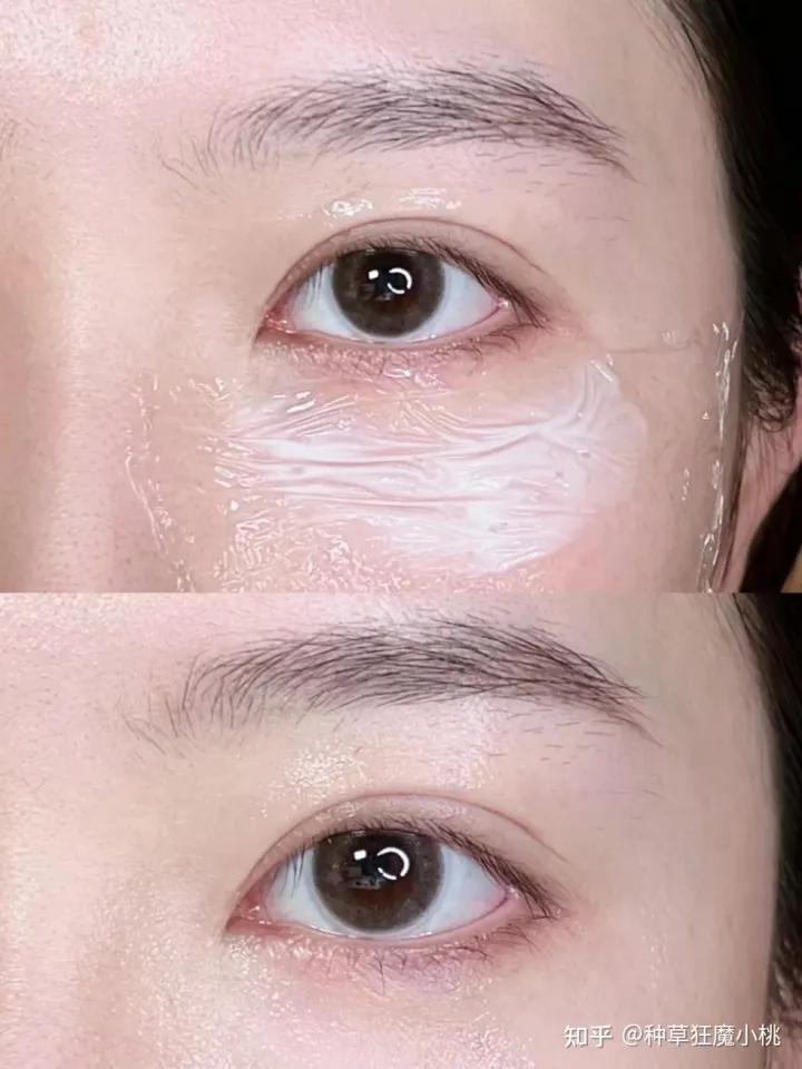 遗传的黑眼圈怎么去掉,如何去掉黑眼圈学生党