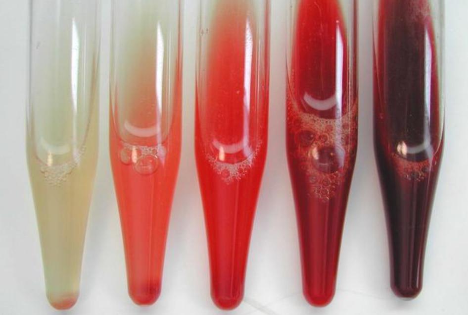 体检尿检呈阳性怎么回事,入职体检尿检有隐血怎么办