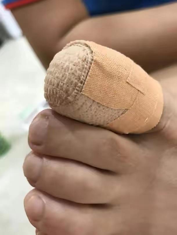 得了灰指甲别着急一个偏方,得了灰指甲去医院拔掉可以吗