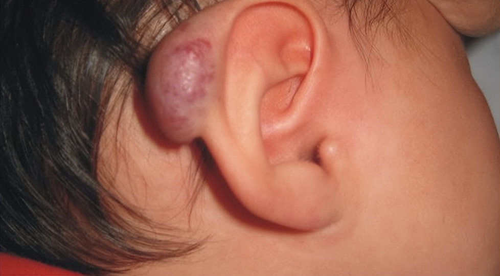 二个月婴儿脸上血管瘤一定会长大,血管瘤能不能等宝宝长大治疗