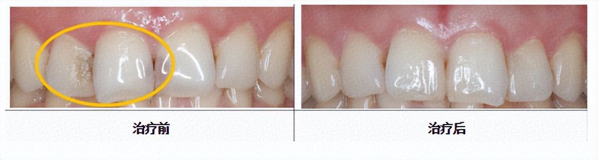 牙齿有蛀牙黑洞怎么办,我的牙齿有洞