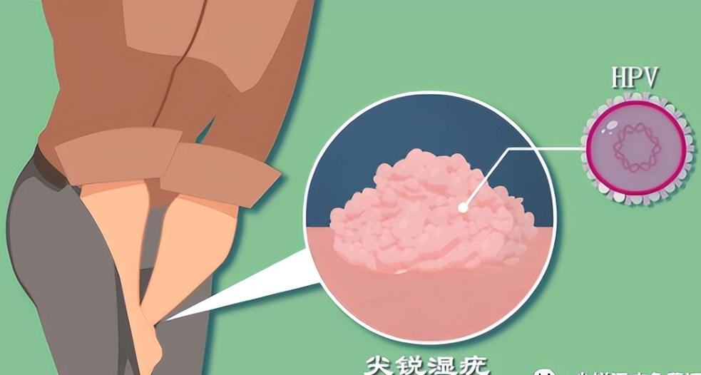 尖锐性湿疣多久不复发算康复了,尖锐性湿疣多久没复发算好了