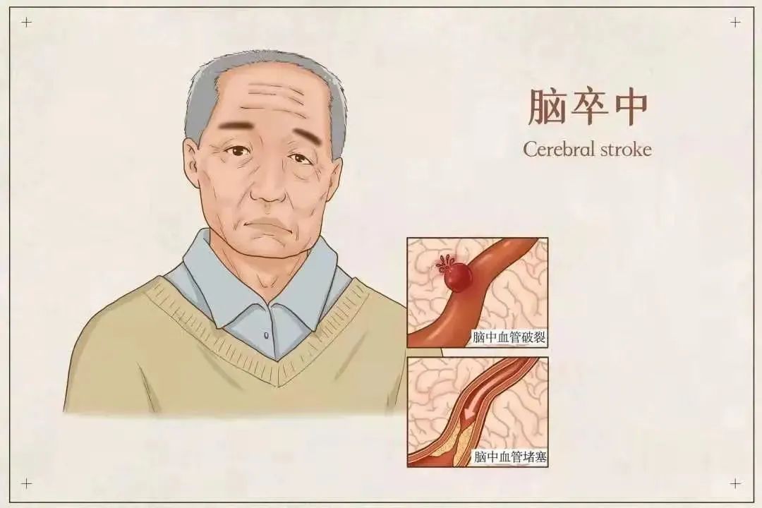 安宫牛黄丸对脑梗有效吗,安宫牛黄丸的那些事儿