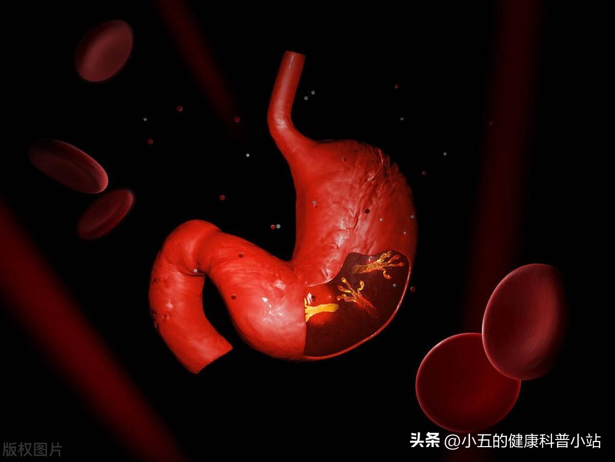 伏诺拉生是治疗反流性食管炎、胃溃疡的新型药物，有什么优势？