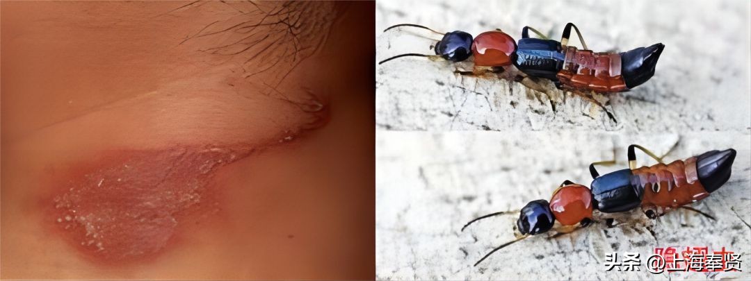 夏季被虫子咬了怎么办,夏季皮肤病攻略虫咬感染篇