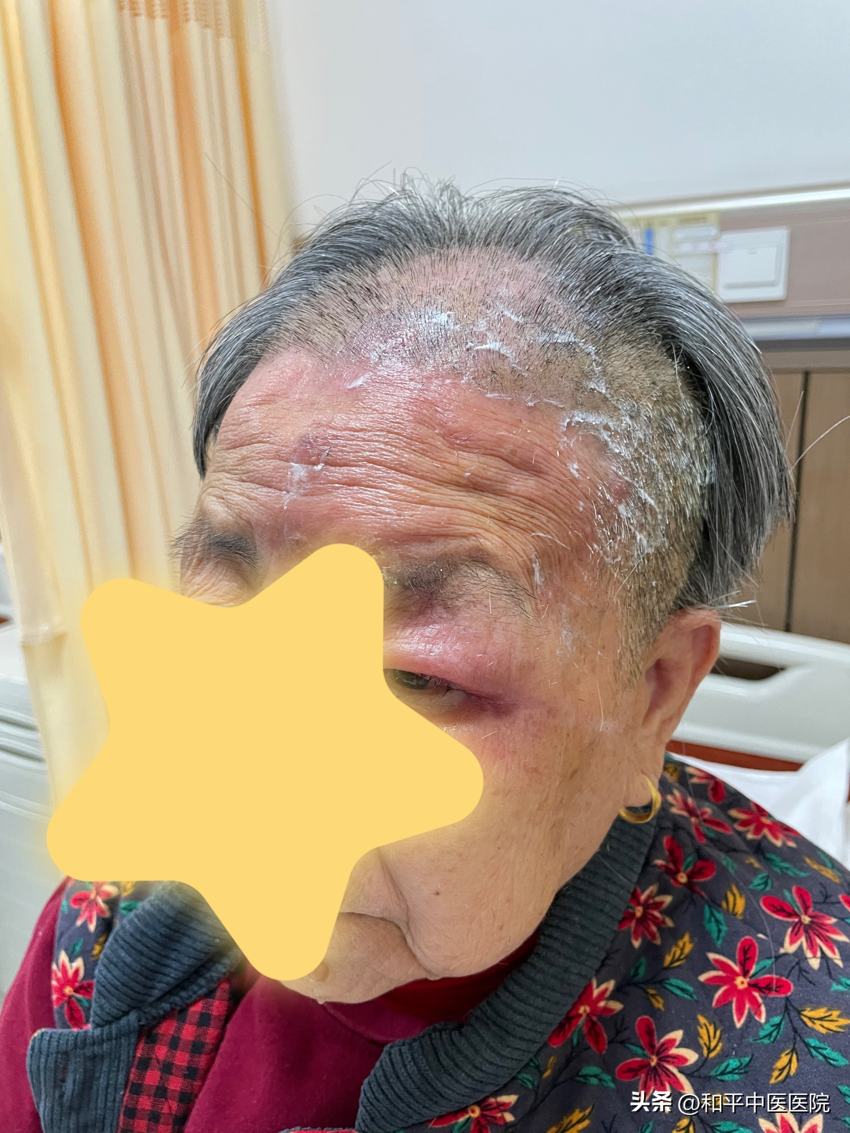 上头！长在这里的带状疱疹真的很危险！