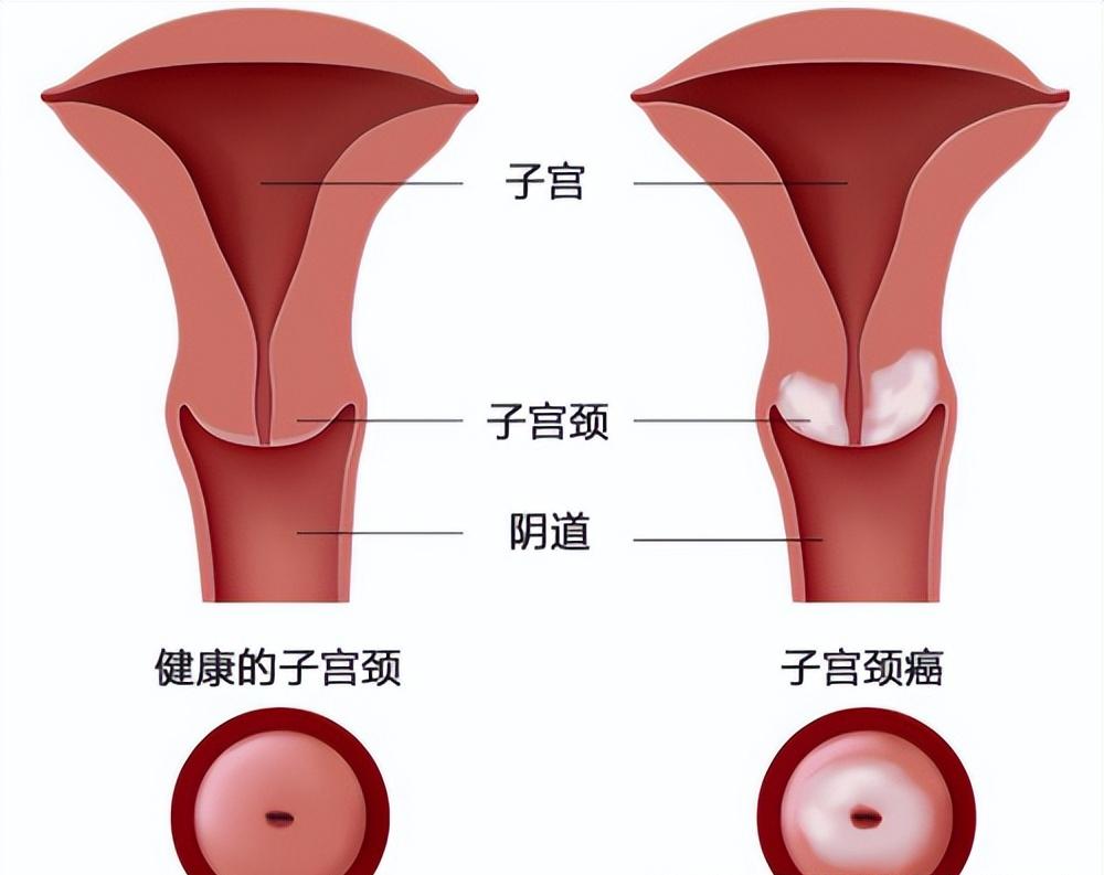 宫颈湿疣激光治疗是怎样的,宫颈尖锐性湿疣用干扰素会好吗