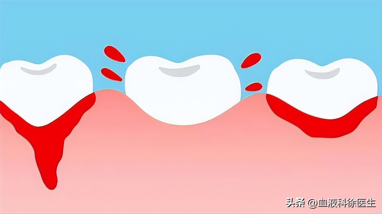 血友病：常被误认为“白血病”，血友病的症状有哪些？