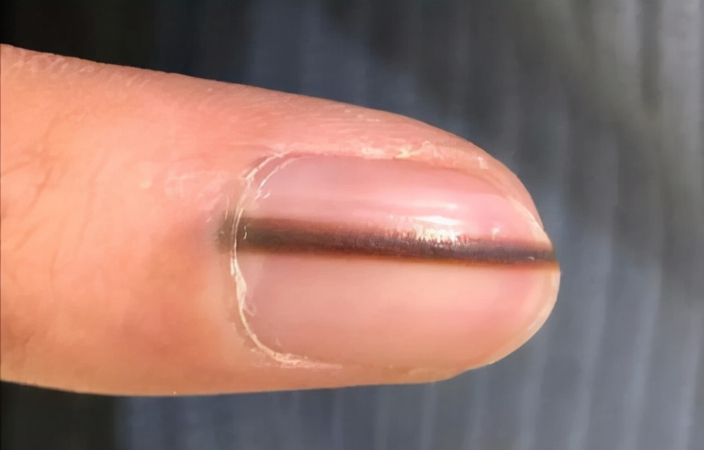 十岁孩子指甲上有竖纹是怎么回事,手指甲出现竖纹是身体哪里的原因
