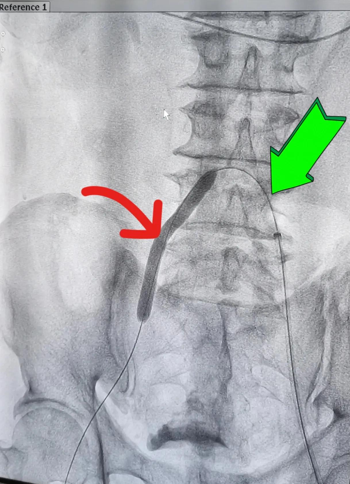 县级医院介入治疗下肢动脉硬化闭塞症