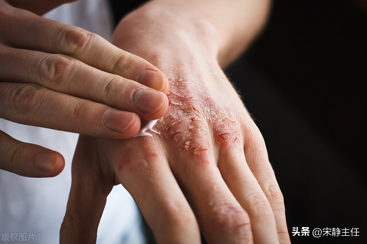 皮肤干燥瘙痒怎么护肤,冬天皮肤干痒如何摆脱