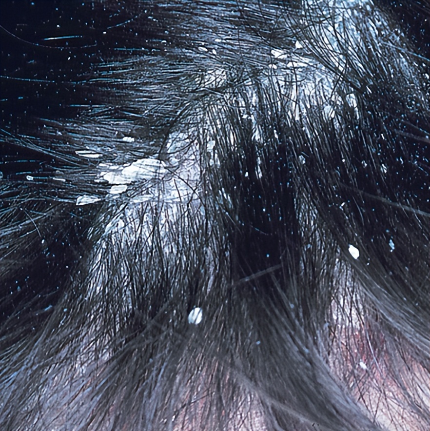 一抓头皮指甲里就有白泥怎么办,头皮一抓指甲里都是白泥