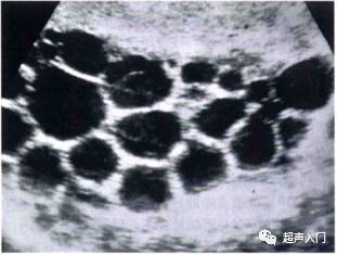 肝包虫病b超能检查出来吗,肝纤维化b超能检查出来吗