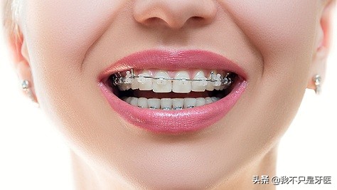 为什么二次口腔正畸矫正会有难度,矫正牙齿怎么选择正畸医生不被坑