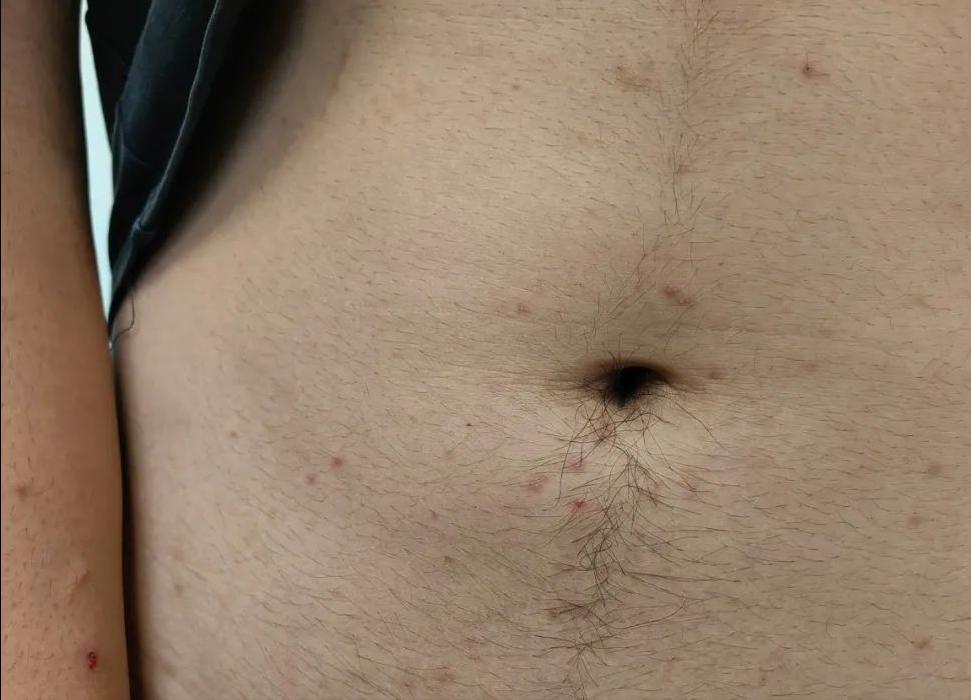 脖子前边痒是生病的前兆,腋窝和脖子痒是什么病的前兆