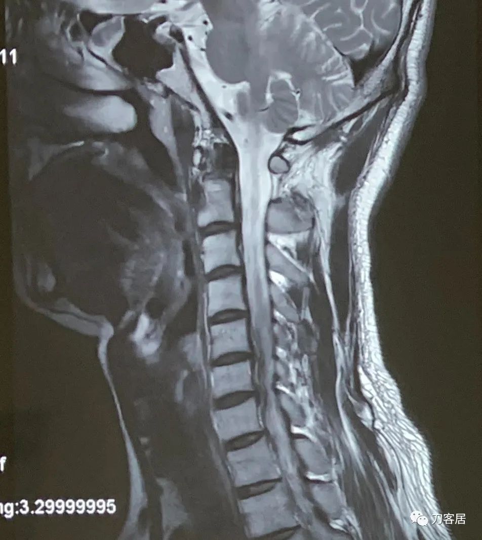 颈椎病七八年了到底要不要动手术,颈椎病不手术保守治疗可以吗
