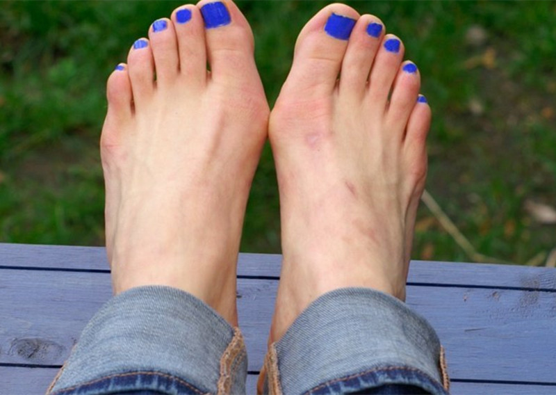 穿鞋挤脚导致脚趾指甲盖疼,拇外翻穿鞋子缓解方法