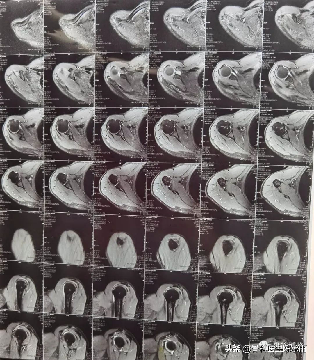 肱二头肌长头肌腱断裂超声报告,上臂肱二头肌