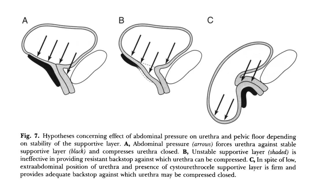 本来不漏尿的盆底肌修复后漏尿,盆底康复训练器漏尿