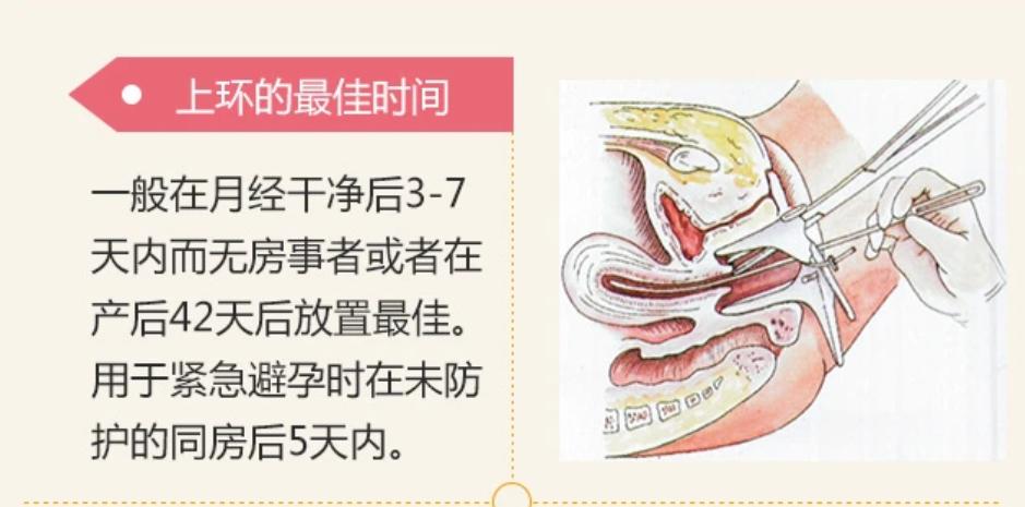 女人上环详细步骤,女性上环流程