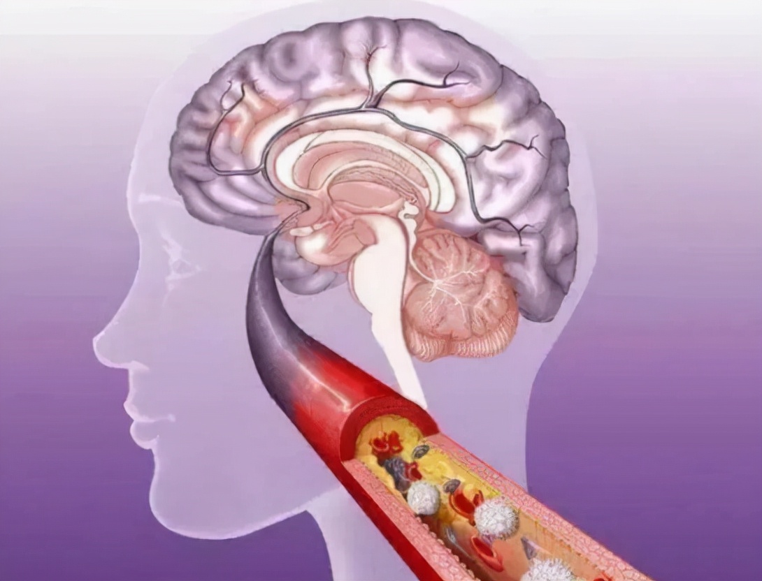 为何如此多的人发生脑梗?要怎么正确应对?一文给您详细讲清楚