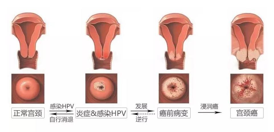 HPV16和HPV18，感染哪个会更严重？