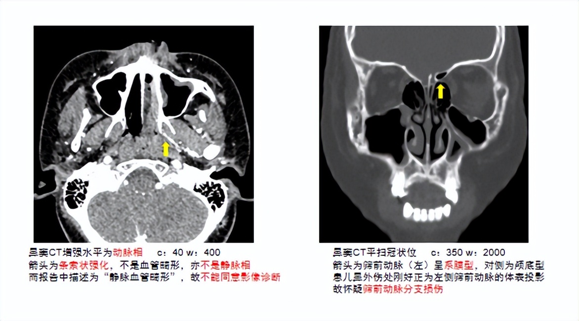 一次摔跤引发的灾难有哪些,一摔跤就流血不止是什么病