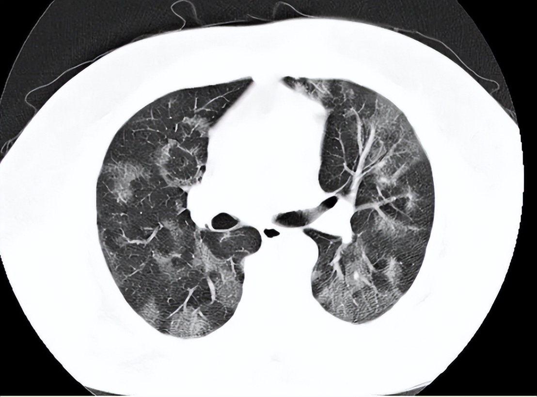 胸腔镜下胸膜冷冻活检，在胸腔积液诊断中，有价值和安全性么