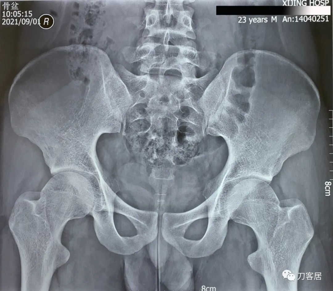 20岁出现峡部裂建议手术吗,20岁腰峡部裂了要不要手术
