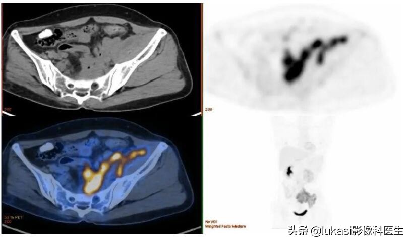 宫颈癌的可怕之处,宫颈癌日益年轻化加强筛查是重点