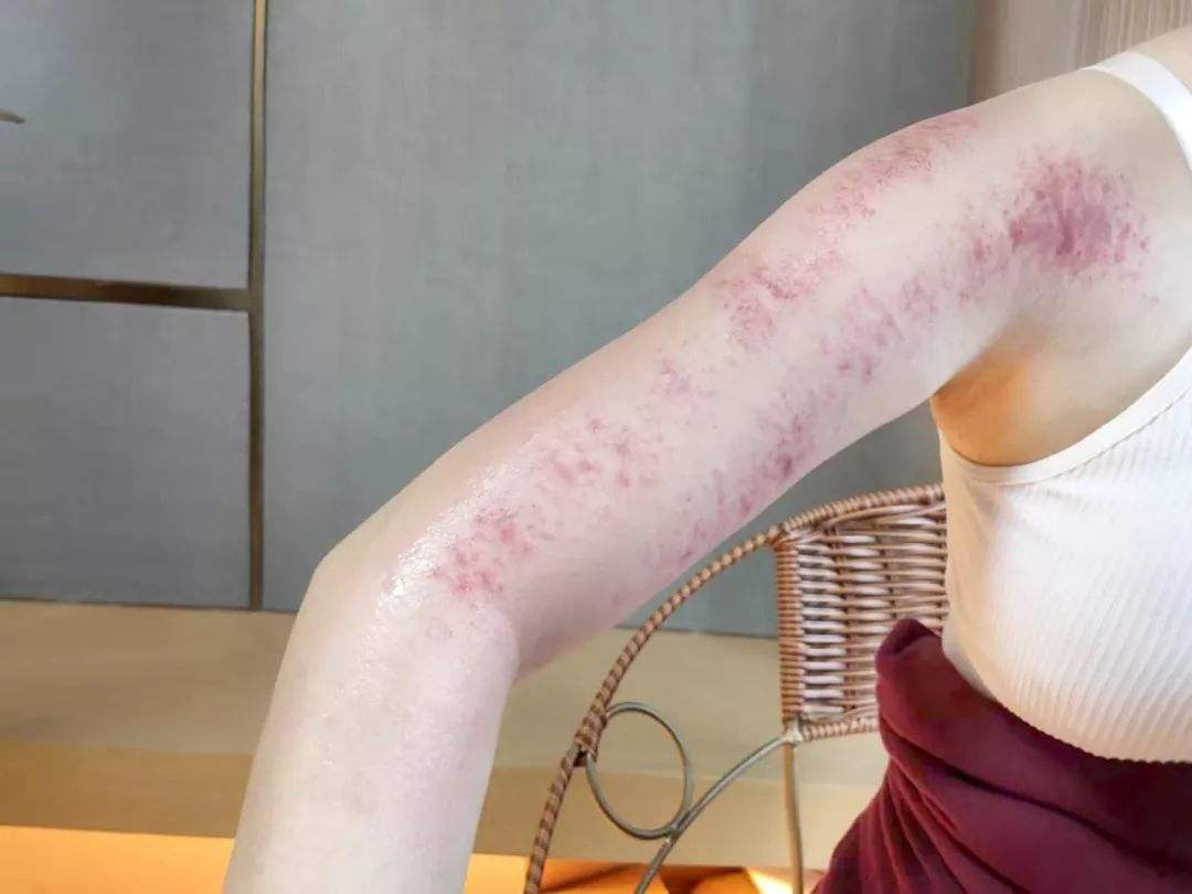 刮痧后痧疹怎样辨别,刮痧前胸出痧图与病症对照