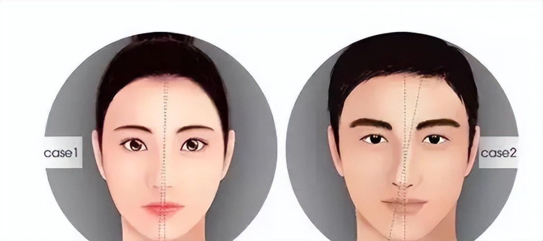 陈国成:歪鼻就是鼻子歪了,但是你知道其实矫正并不难吗?