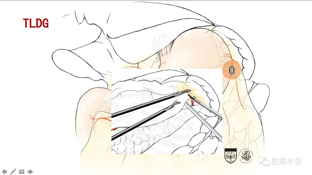 全腹腔镜胃癌根治术，学习大咖怎么清扫淋巴结