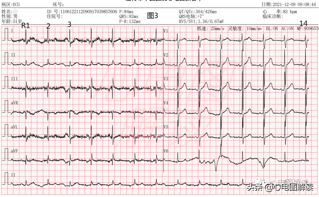 心电图房性心律窦性心律,房性心律与房性自主心律分类