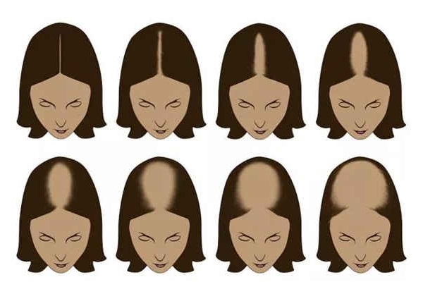女性脱发严重10个原因,女性脱发最新研究