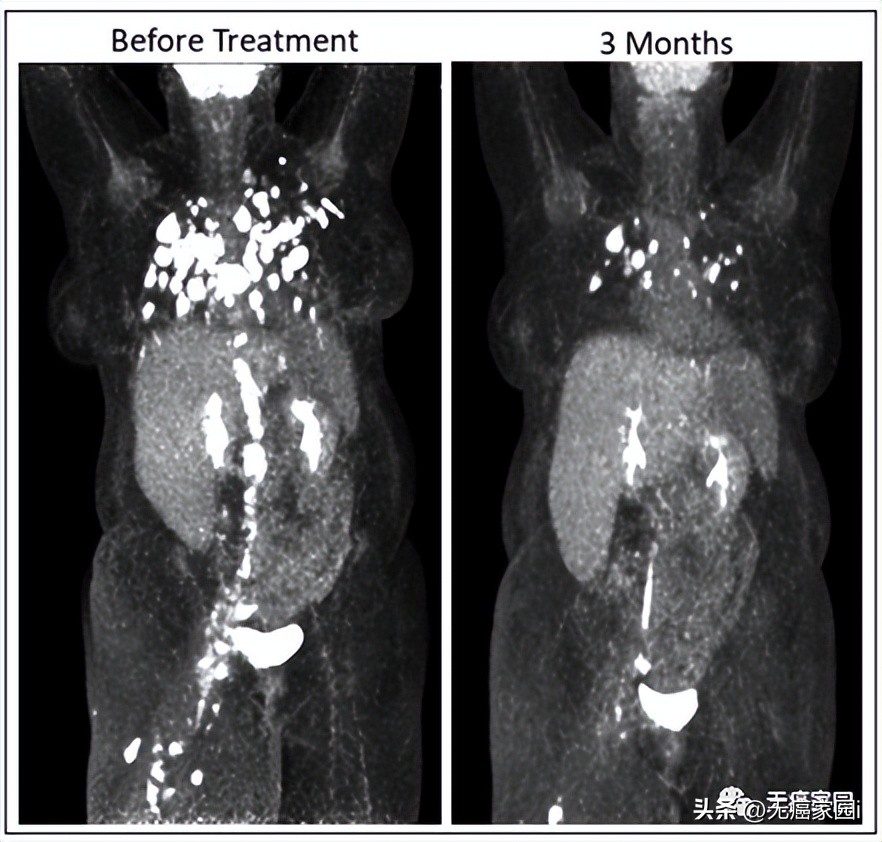 tcr-t疗法可以治疗哪些肿瘤,tcr-t细胞疗法成功率