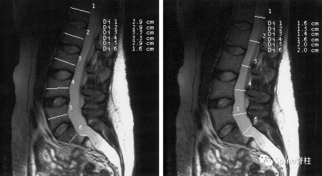 硬膜扩张,duralectasia