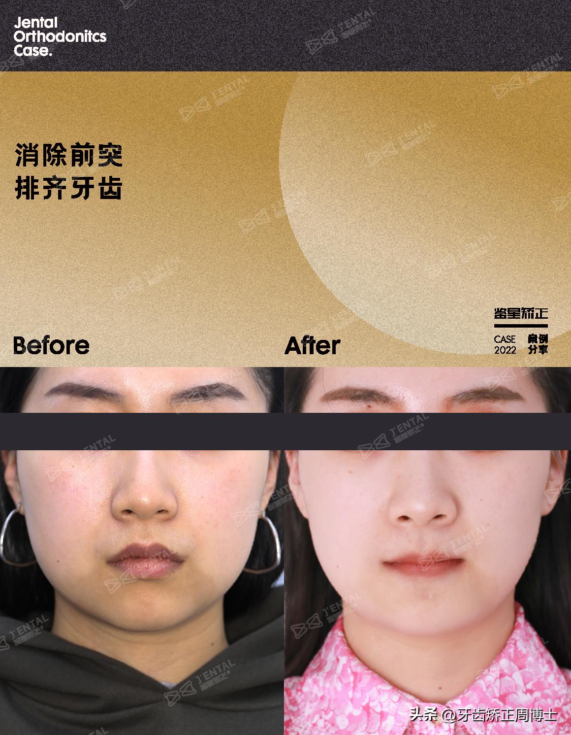 即刻种植即刻修复免受缺牙的痛苦,缺牙不补倾斜矫正价钱