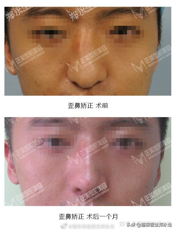 截骨歪鼻矫正术多少钱,歪鼻矫正必须要截骨吗