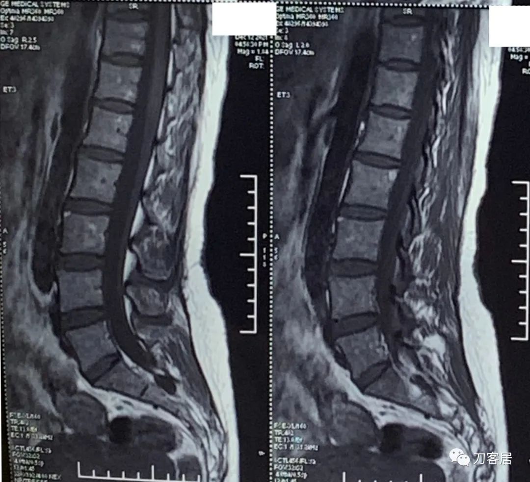 50多岁女性剧烈腰痛,40岁女人腰痛是什么原因引起的