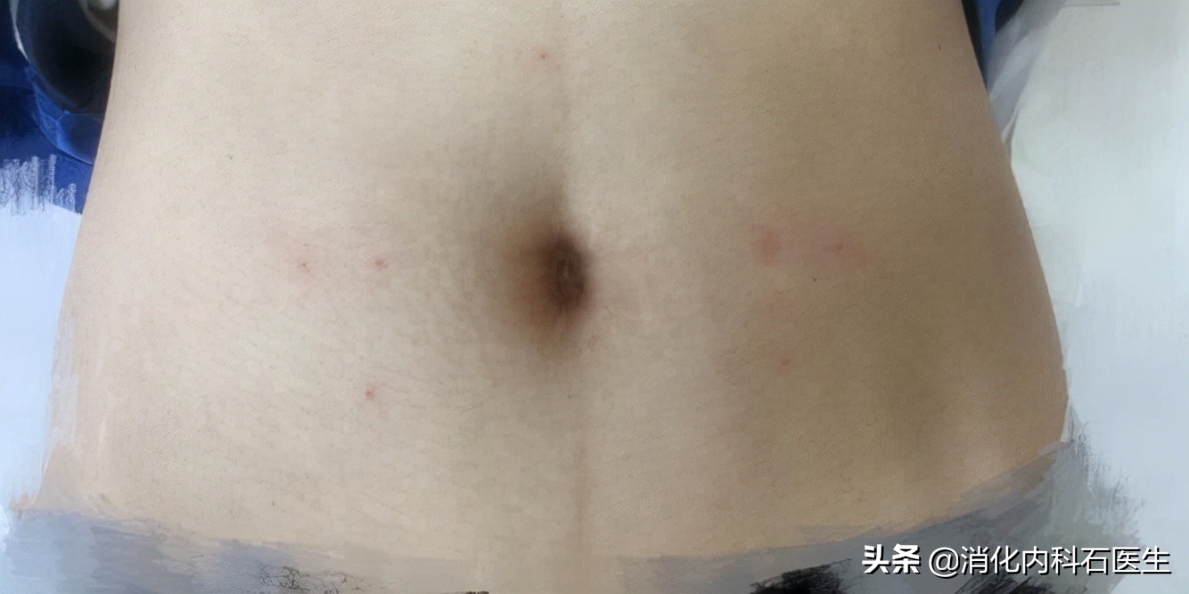 大出血流产女子肚子疼,流产后子宫穿孔