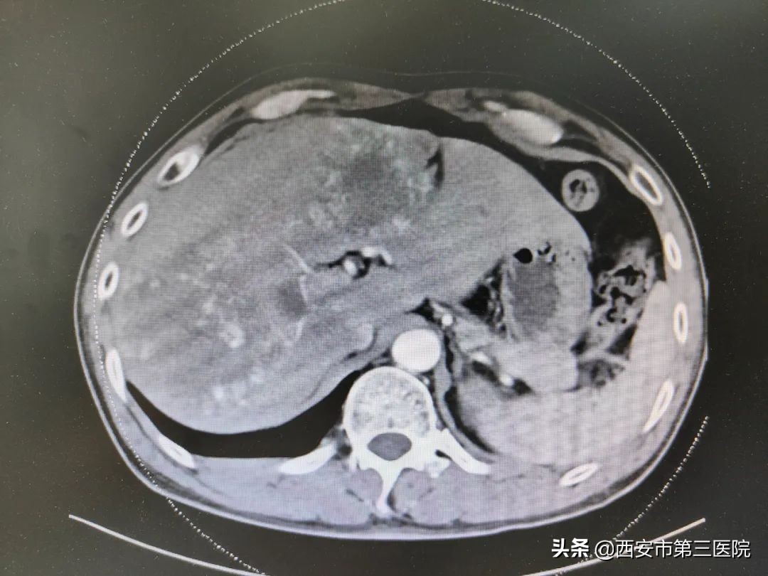 沈阳治疗肝血管瘤介入哪家医院好,肝血管瘤介入手术大概需要多少钱