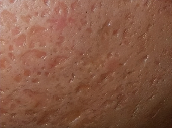 治疗痘印最有效的医美手段,脸部痘印中医能治疗嘛