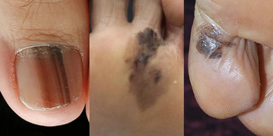 甲母痣癌变几率多大,多大的痣会癌变