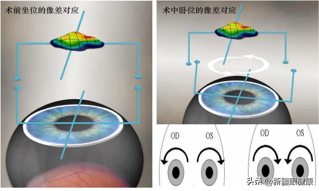 NBA球迷看过来：詹皇同款摘镜术式