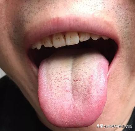 寒热舌诊图解大全,如何看舌象判断疾病准确用药