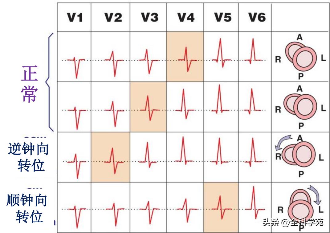 心电图qrs间期变长是怎样造成的,心电图qrs振幅多少是正常范围