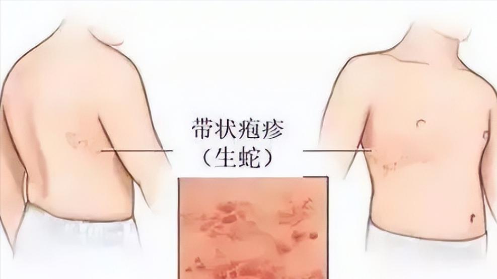 得了带状疱疹又痛又痒医生提醒,有不疼的带状疱疹症状和表现