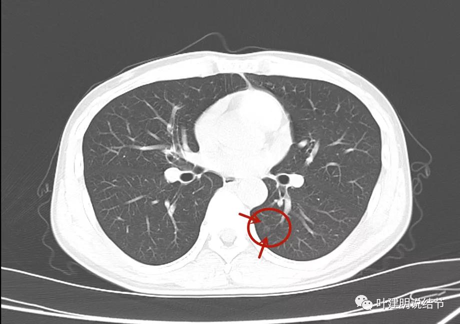 这样的多发病灶给试验性抗结核治疗?消失的结节是药的功劳吗?