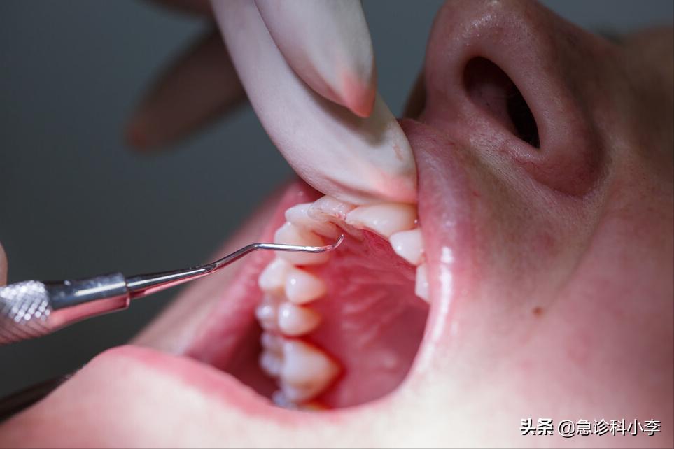 在牙缝里的牙结石要怎么去除,牙缝的牙结石怎么自己去除